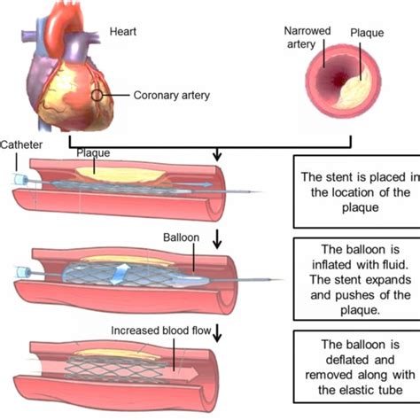 Some Ideal Characteristics Of Stents Download Scientific Diagram