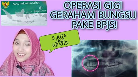 Sharing Pengalaman Operasi Gigi Geraham Bungsu Menggunakan Bpjs