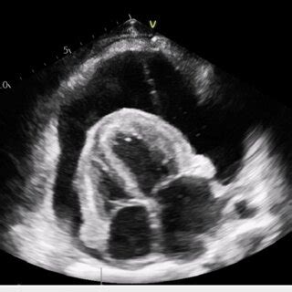 Standard echocardiographic views are used to assess a pericardial ...