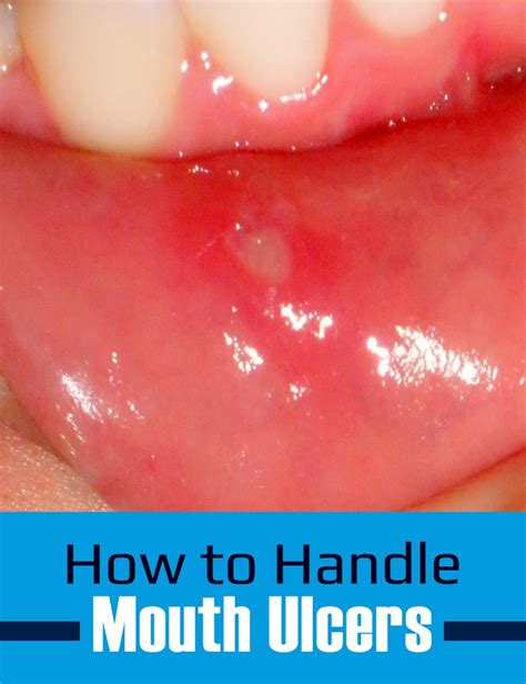 How To Handle Mouth Ulcers Health Smartly