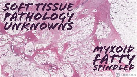 Soft Tissue Pathology Unknowns Myxoid Fatty And Spindled Lesions