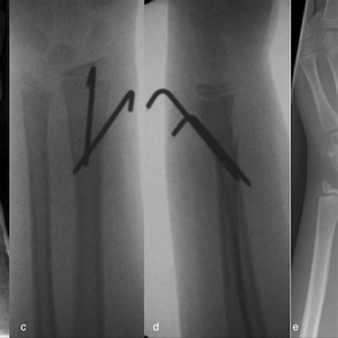 A B Preoperative Radiographs Antero Posterior And Lateral Views C D Download Scientific