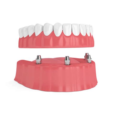 Common Problems With Snap-In Dentures | Smile Bright Dentures