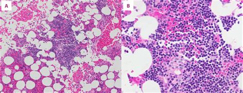 A B Hematoxylin And Eosin Sections Of Clot Show Bone Marrow With