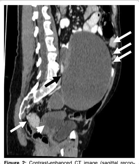 Figure 2 From Splenosis Mimicking Peritoneal Implants In A Female With