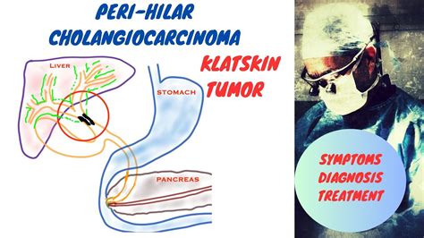 Hilar Cholangiocarcinoma Klatskin Tumor Youtube