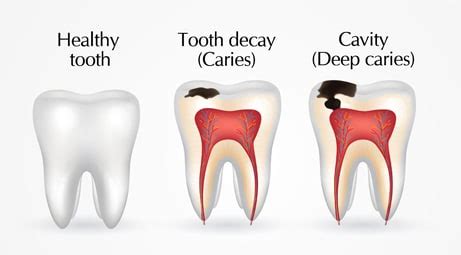 Everything You Need to Know About Cavities Between Your Teeth ...