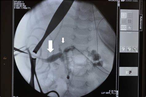 Intraoperative Cholangiogram Demonstrating An Adequate Size Gallbladder