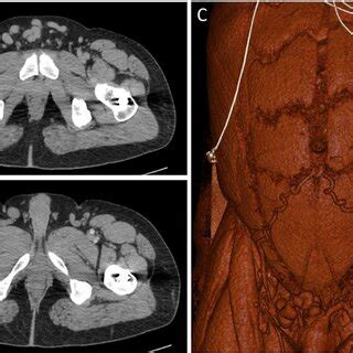 CT Images Through The Pelvis Show The Dilated Collateral Veins A In