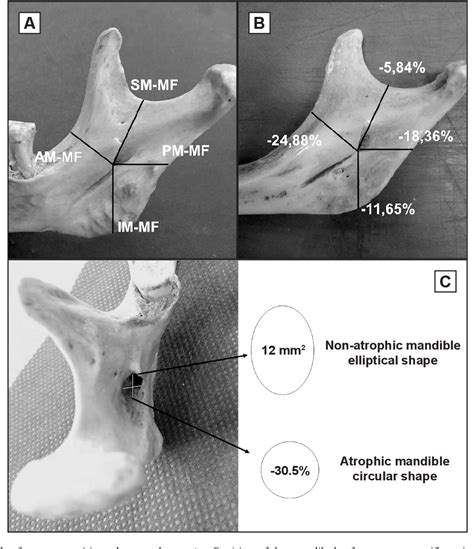 Figure From Anatomical Variation In The Mandibular Foramen In Non