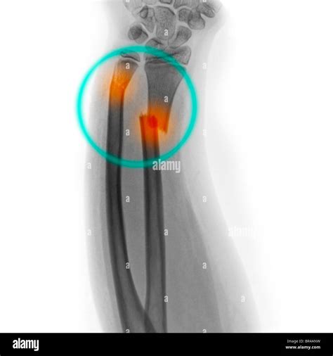 Forearm X Ray Of A Year Old Girl Showing Fractures Of The Distal