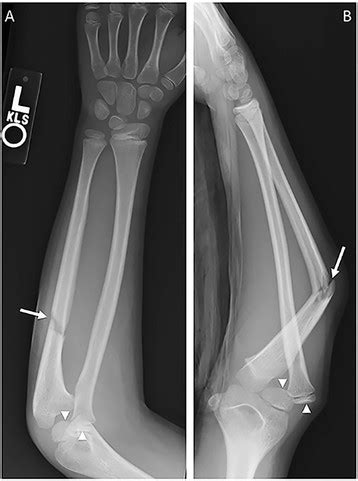 Monteggia fracture. PA (a) and lateral (b) radiographs of the forearm ...