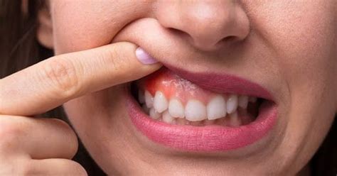 Sinais De Problema Nas Gengivas E Dentes Blog