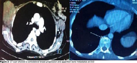 Figure 1 From Primary Squamous Cell Carcinoma Of The Breast A Case