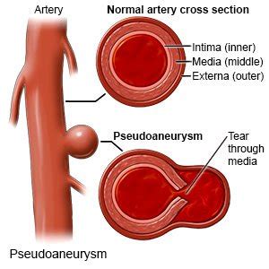 Pseudoaneurysm - What You Need to Know