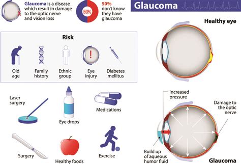 Glaucoma Treatment Honolulu HI - Intraocular Pressure Solutions