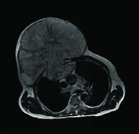 Thoracic Mri Axial T Image Demonstrates A Large Infiltrative