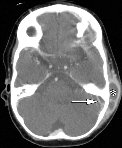 Superior Sagittal Sinus Thrombosis