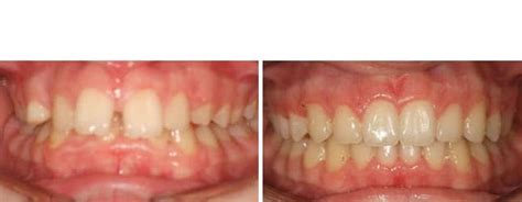 Overjet Before And After