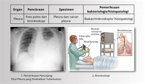 Tuberkulosis Tbc Pleura Yayasan Kncv Indonesia