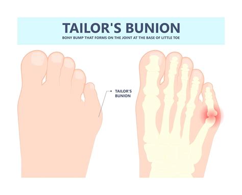 Tailor's Bunion And Bunion On Same Foot Online | emergencydentistry.com