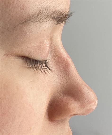 Female Long Nose Rhinoplasty Side 1 Dr Barry Eppley Explore Plastic