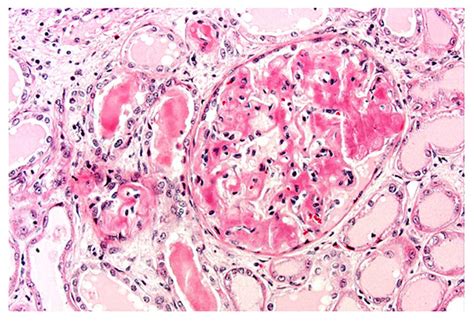 Renal Biopsy Showing Obliteration Of Glomerular Architecture By Download Scientific Diagram