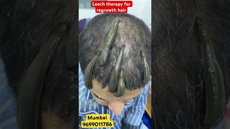 Leech Therapy For Hair Loss