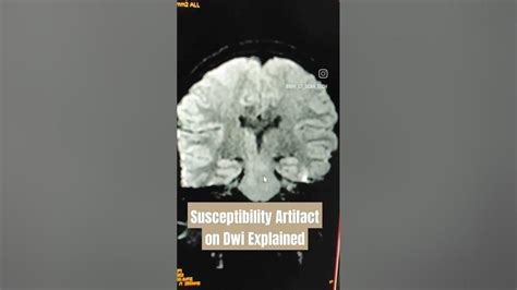 Susceptibility Artifact On Dwi Explained Youtube