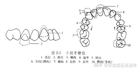 错颌畸形的分类 Angle错合分类法 知乎