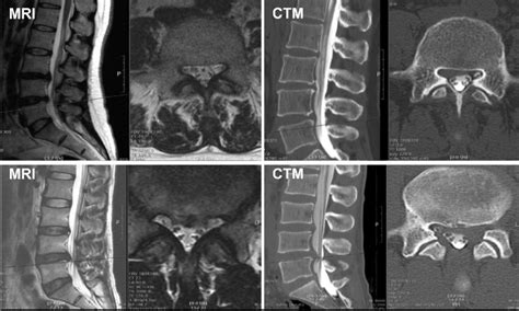 A Preoperative Magnetic Resonance Imaging Mri T2 And Computed Download Scientific Diagram