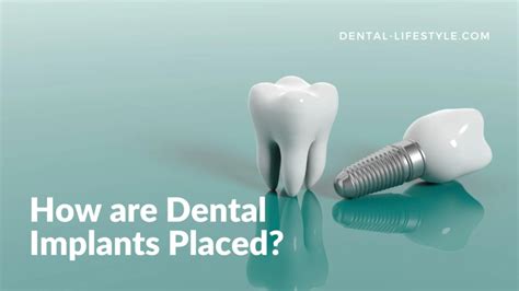 How Are Dental Implants Placed Oral Health Tips And Tricks Dental Lifestyle