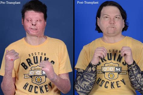 Incredible Surgical Transformation Of Burn Victim Joe Dimeo