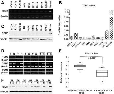 TGM3 MRNA And Protein Levels Are Illustrated In HNSCC Specimens And