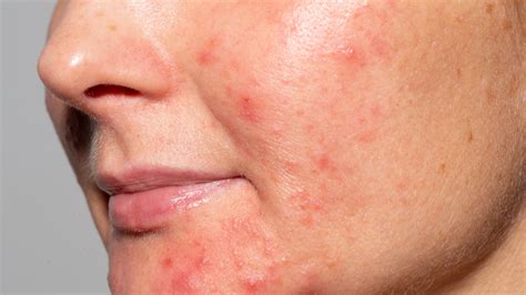 Why You Should Never Pick At Cystic Acne And How To Treat It Instead