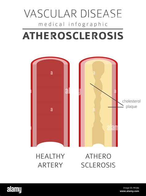 Las Enfermedades Vasculares Los S Ntomas De La Aterosclerosis El