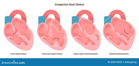 Congenital Diseases Of The Heart Set Ventricular And Atrial Septal