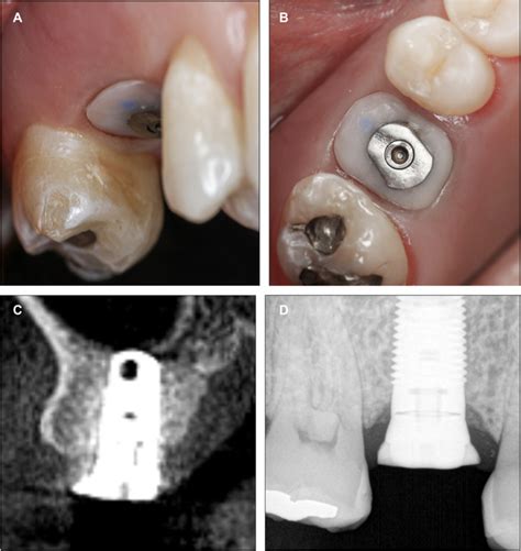 Clinical Advantages Of Immediate Posterior Implants With Custom Healing