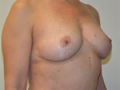 Breast Lift 13 Before After Gallery Allen Doezie MD FACS