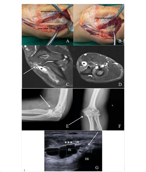 Figure A Aa Year Old Male Patient With Cubital Tunnel Syndrome Caused