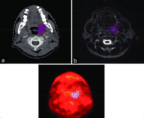 A Oropharyngeal Lesion Seen On Computed Tomography B Same Lesion