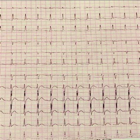 Lead Electrocardiogram Showing Atrial Tachycardia With A Heart Rate