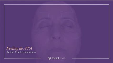 Peeling de ATA Ácido Tricloroacético Facial Class YouTube