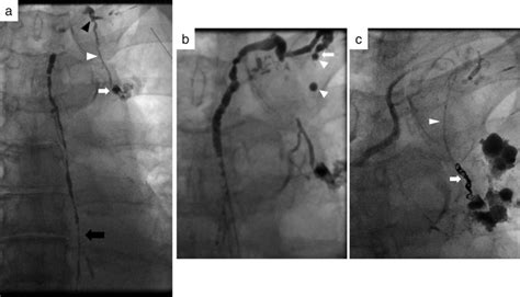 Fluoroscopic Images A Thoracic Ductography With A Lipiodol Injection