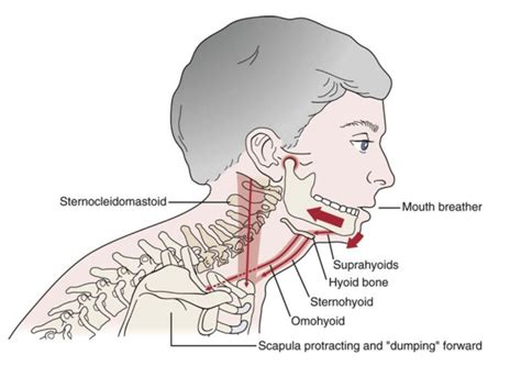 A Pandemic Of Forward Head Posture Fhp Drbonnie360