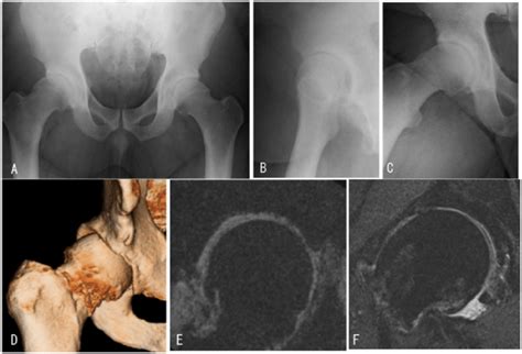 Preoperative Imaging A Preoperative Anteroposterior Ap Radiograph Download Scientific