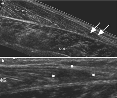 Imaging Semiology Ultrasound And Mri In The Assessment Of Muscle Injury Musculoskeletal Key