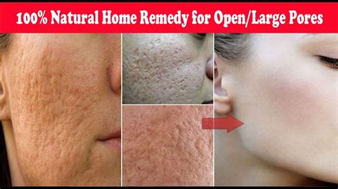 Open Pores Reduce Open Pores On Face By Home Remedy Recibeauty