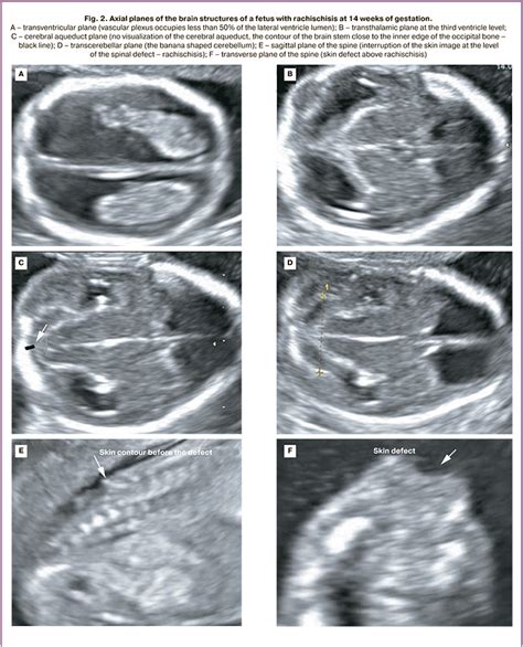 Arnold Chiari Malformation Spina Bifida