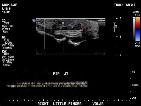 Giant Cell Tumor Of Tendon Sheath Image